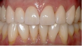 Dennington Dental - Napa Porcelain Veneers - Upper AFTER