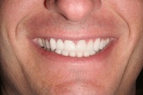 Dennington-Full-Porcelain-Veneers-After