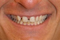 Dennington-Full-Porcelain-Veneers-Before