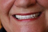 Dennington Dental Napa Porcelain-Veneers-After