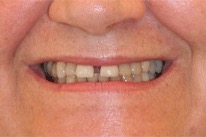 Dennington Dental Napa Porcelain-Veneers-Before